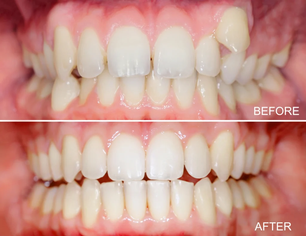 before and after teeth straightening results